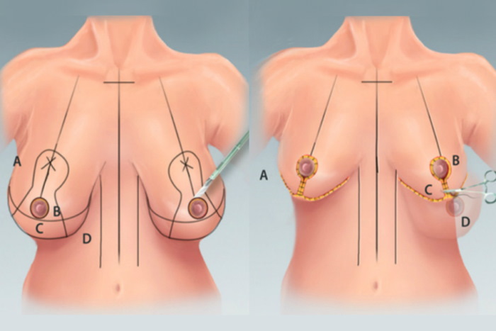 Уменьшение груди пластикой