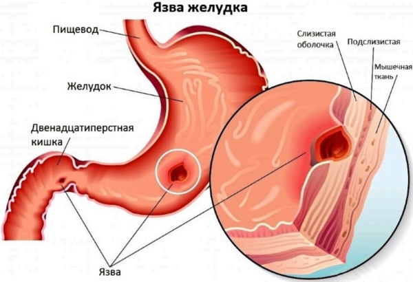 Канефрон при беременности 1-2-3 триместр. Инструкция по применению