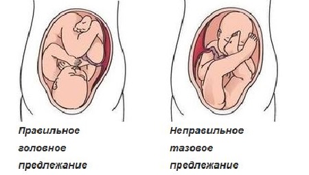 Катетер для раскрытия шейки матки перед родами. Зачем, как ставят для стимуляции родов, как действует
