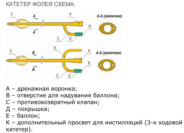 Катетер для раскрытия шейки матки перед родами. Зачем, как ставят для стимуляции родов, как действует