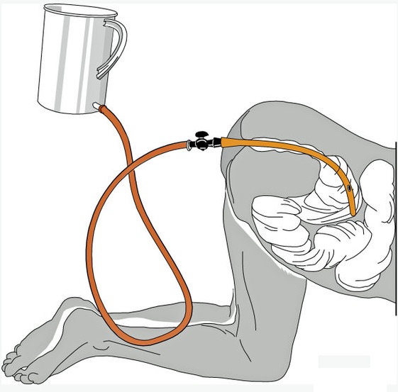 Кесарево сечение: плюсы и минусы для ребенка и мамы. Показания, последствия, восстановление. Советы и мнения специалистов
