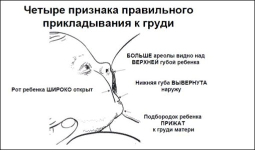 Колики у новорожденного. Что делать, лечение в домашних условиях. Когда начинаются, заканчиваются, симптомы, лекарства, газоотводная трубка