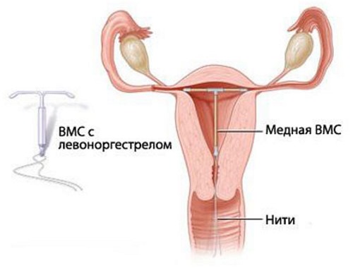 внутриматочная спираль