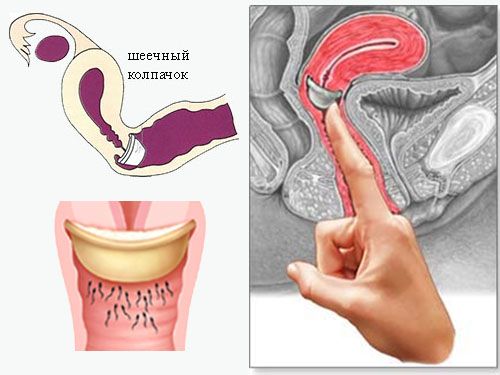 шеечный колпачок