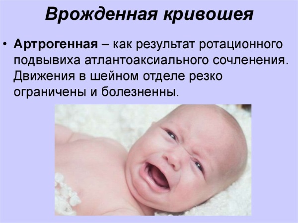 Кривошея у новорожденных. Причины, признаки, фото и лечение