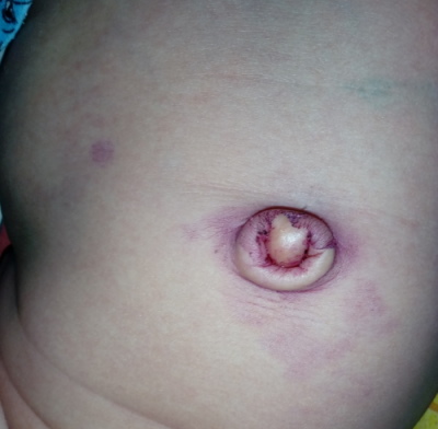 Кровит пупок у новорожденного. Что делать, причины