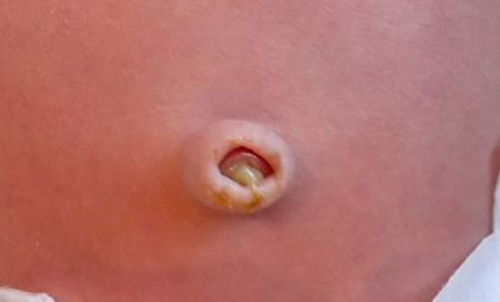 Кровит пупок у новорожденного. Что делать, причины