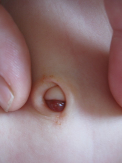 Кровит пупок у новорожденного. Что делать, причины