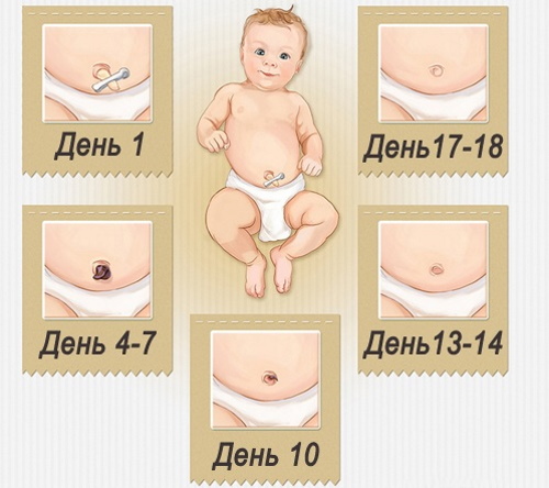 Кровит пупок у новорожденного. Что делать, причины