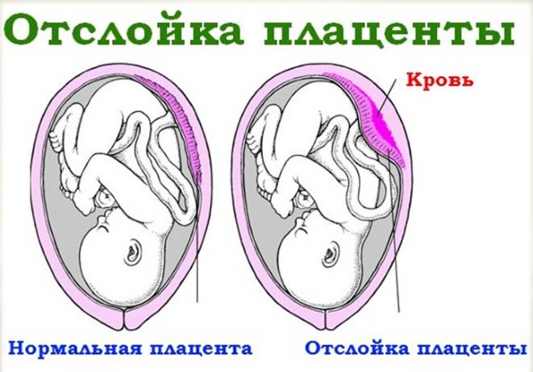 Транексам при беременности на ранних сроках. Для чего назначают, сколько принимать. Инструкция