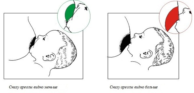 Лактостаз у кормящей матери: симптомы и лечение с температурой и без в домашних условиях