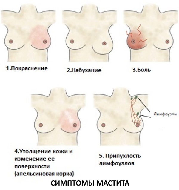 Лактостаз у кормящей матери: симптомы и лечение с температурой и без в домашних условиях