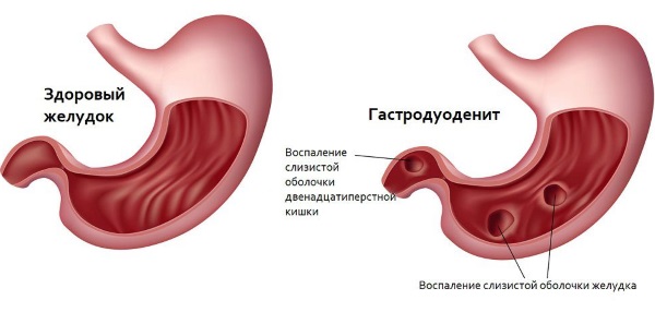 Лямблиоз у детей. Симптомы и лечение, препараты, народные средства