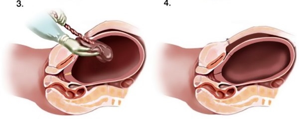 Маловодие при беременности: причины и последствия, чем опасно для ребенка умеренное, выраженное. Лечение