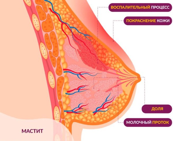 Мастит у кормящей матери. Признаки, фото, как определить, лечение в домашних условиях