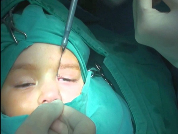 Закупорка слезного канала у новорожденных. Симптомы непроходимости, массаж, народные средства, лечение лазером, операция