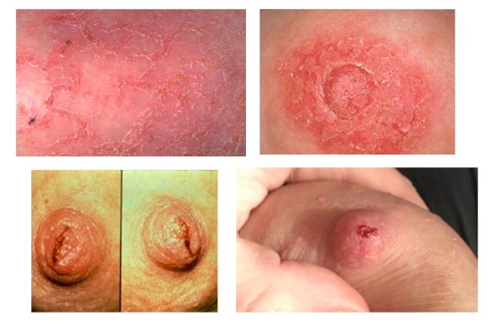 Медела (Medela) крем от трещин. Инструкция по применению, цена, отзывы