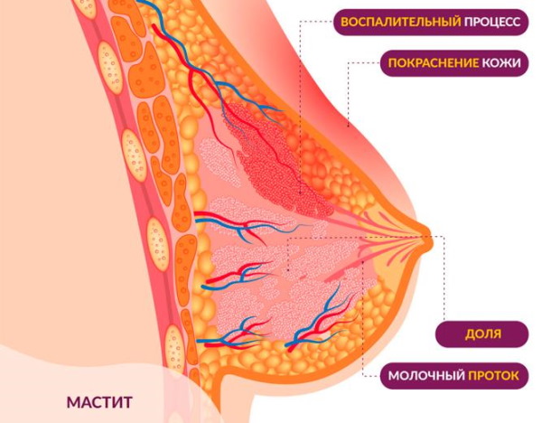 Медела (Medela) накладки для грудного вскармливания. Инструкция, размеры, где купить, как надеть, цены