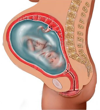 Многоводие при беременности. Причины и последствия на поздних сроках. Как определить, лечение