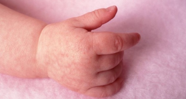 Мраморная кожа у грудничков. Причины, фото, лечение, что это значит