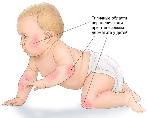 Можно ли зефир при грудном вскармливании?