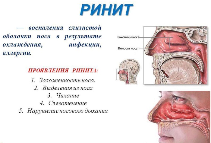 Как лечить насморк у ребенка 3 года. Народные средства, лекарства из аптеки