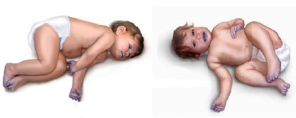 ОАП сердца у новорожденных. Что это такое, размеры, норма у детей, УЗИ, лечение, операция