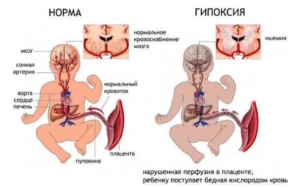 Обвитие пуповиной вокруг шеи плода 1 раз, двойное, тройное. Причины и последствия, как распознать, что делать