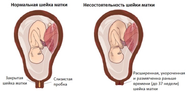 Самые опасные недели беременности во всех триместрах