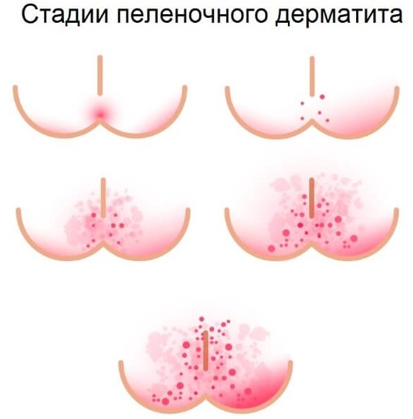 Опрелости у новорожденных. Чем лечить: медицинские и народные средства. Как выглядят на попе, шее, под мышками, между ног