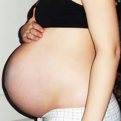 Опущение живота перед родами у первородящих. Как определить