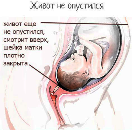 Опущение живота перед родами у первородящих. Как определить