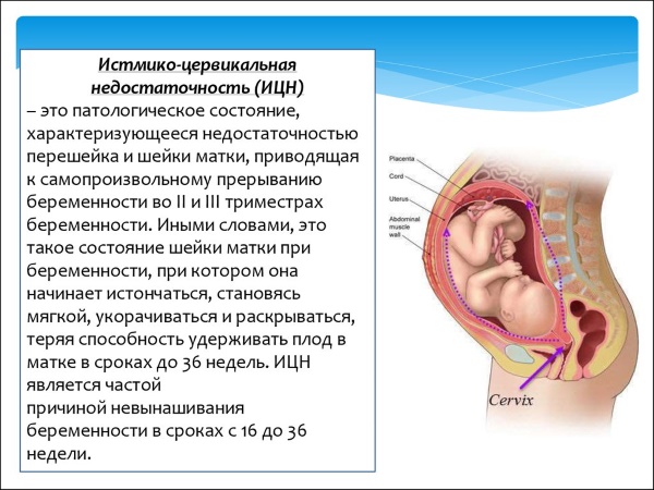 Отслойка плодного яйца на ранних сроках беременности. Последствия, причины