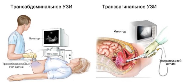 Отслойка плодного яйца на ранних сроках беременности. Последствия, причины