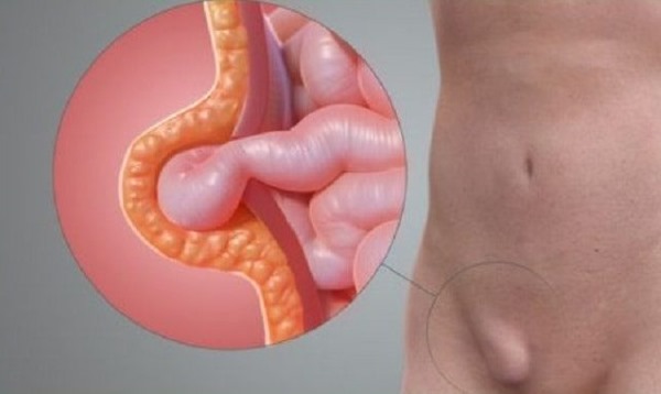 Паховая грыжа у ребенка. Фото 1, 2, 3 года, 5 лет. Лечение народными средствами, операция