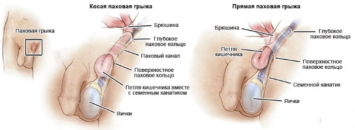 Паховая грыжа у ребенка. Фото 1, 2, 3 года, 5 лет. Лечение народными средствами, операция