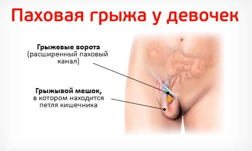 Паховая грыжа у ребенка. Фото 1, 2, 3 года, 5 лет. Лечение народными средствами, операция