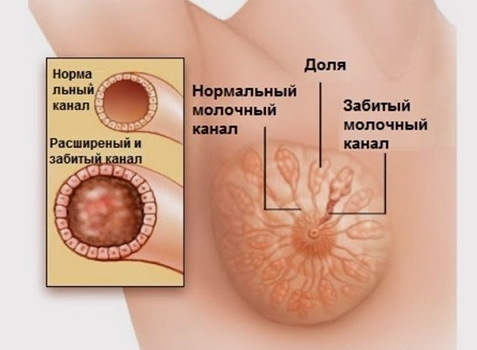 Перетягивание грудного молока. Как долго перегорает, последствия