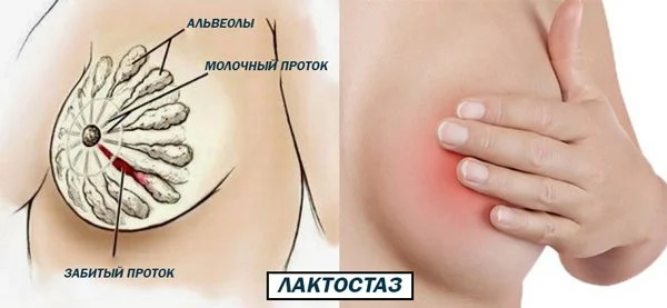 Перетягивание грудного молока. Как долго перегорает, последствия