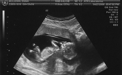 Первый скрининг при беременности. Как делают, сроки, что показывает, как подготовиться, нормы расшифровка УЗИ, опыт женщин на форумах