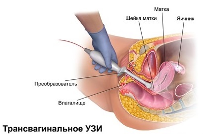 Первый скрининг при беременности. Как делают, сроки, что показывает, как подготовиться, нормы расшифровка УЗИ, опыт женщин на форумах