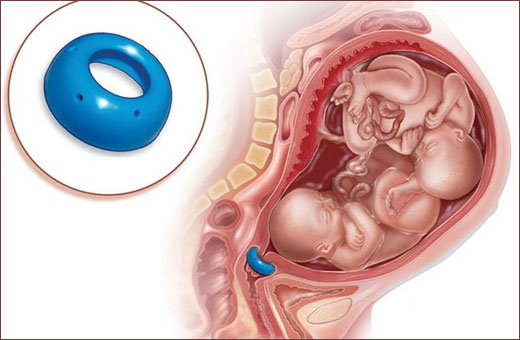 Пессарий акушерский. Что это такое, установка при беременности, размеры, цена