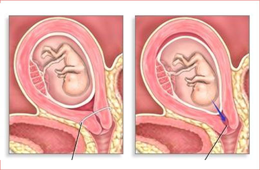 Пессарий акушерский. Что это такое, установка при беременности, размеры, цена