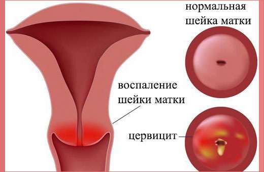 Пессарий акушерский. Что это такое, установка при беременности, размеры, цена