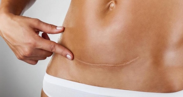 Плановое кесарево сечение. На каком сроке делают, подготовка, как происходит, отзывы