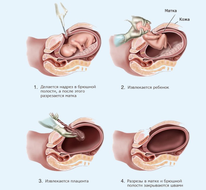 Плановое кесарево сечение. На каком сроке делают, подготовка, как происходит, отзывы