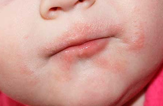Покраснение вокруг рта у ребенка. Фото, причины и лечение, рацион питания