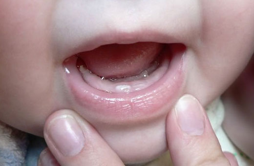 Покраснение вокруг рта у ребенка. Фото, причины и лечение, рацион питания