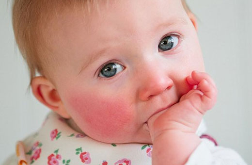 Покраснение вокруг рта у ребенка. Фото, причины и лечение, рацион питания