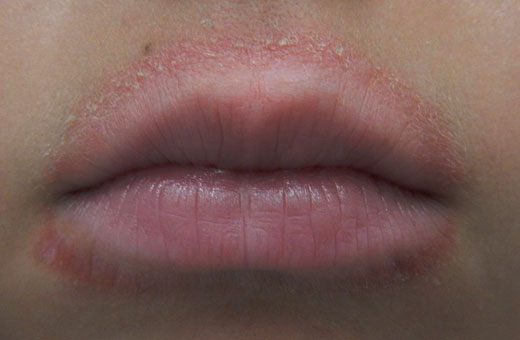 Покраснение вокруг рта у ребенка. Фото, причины и лечение, рацион питания